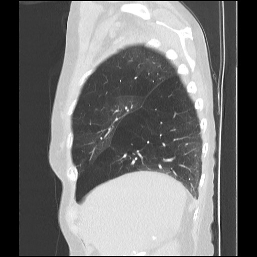 Alpha-1-antitrypsin deficiency (Radiopaedia 64893-73840 Sagittal lung window 11).jpg