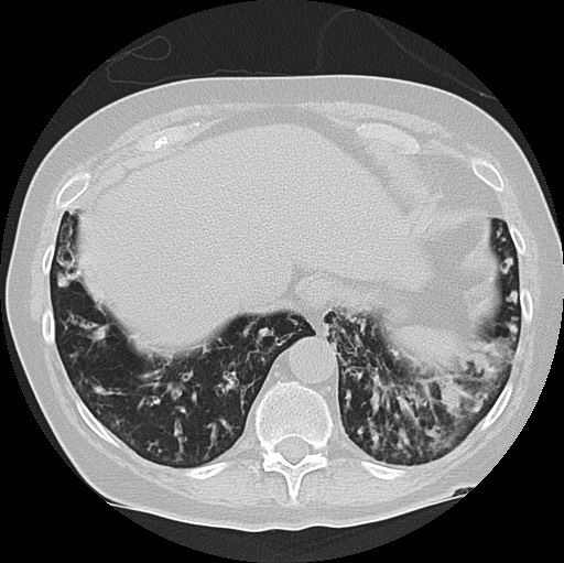 File:Alpha-1-antitrypsin deficiency (Radiopaedia 72058-82557 Axial lung window 60).jpg