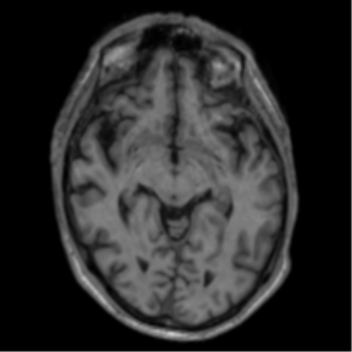 Alzheimer's disease- with apraxia (Radiopaedia 54763-61011 Axial T1 33).png