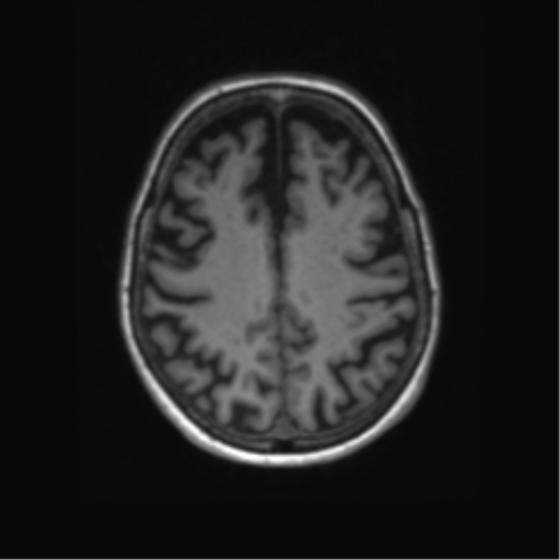 Alzheimer's disease (Radiopaedia 42658-45802 Axial T1 49).png