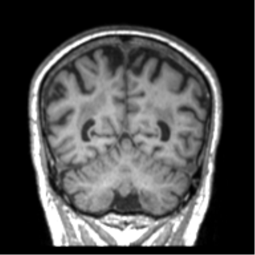 Alzheimer disease and cerebral amyloid angiopathy (Radiopaedia 64234-73011 Coronal T1 11).png