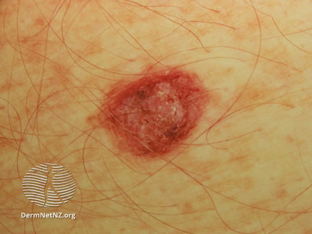 File:Amelanotic melanoma (DermNet NZ amelanotic-melanoma-021).jpg