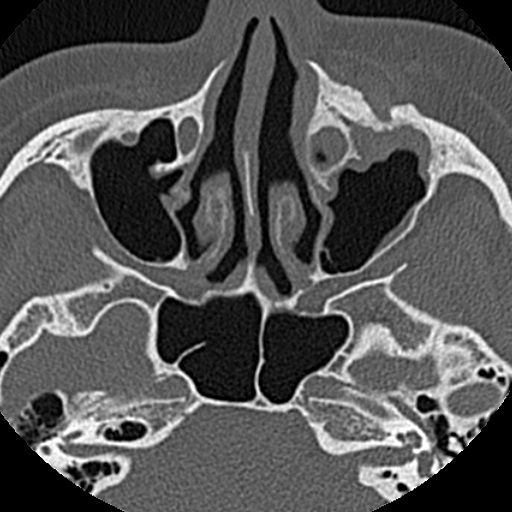 Ameloblastic fibro-odontoma (Radiopaedia 18843-18780 C 10).jpg