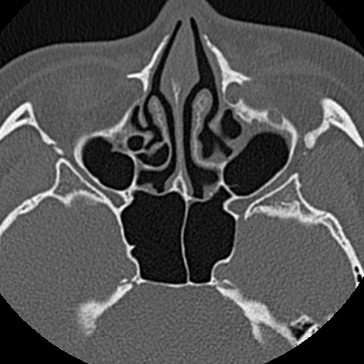 File:Ameloblastic fibro-odontoma (Radiopaedia 18843-18780 C 3).jpg