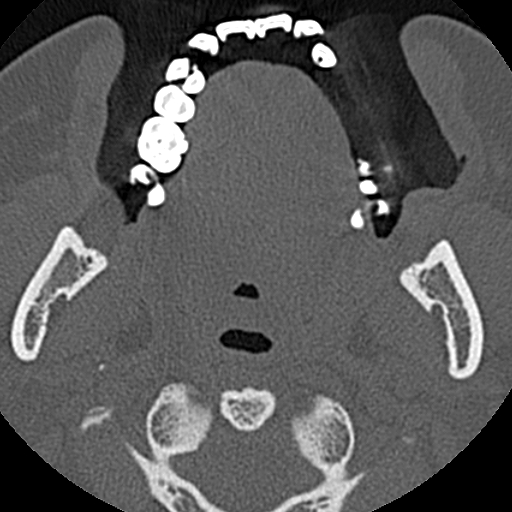 File:Ameloblastic fibro-odontoma (Radiopaedia 18843-18780 C 56).jpg