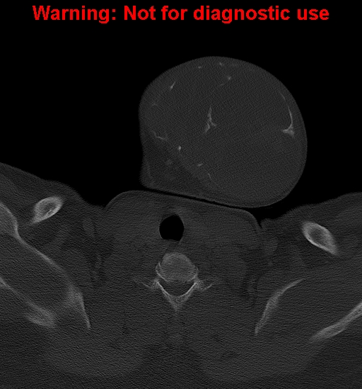 Ameloblastoma (Radiopaedia 33126-34164 Axial bone window 36).jpg