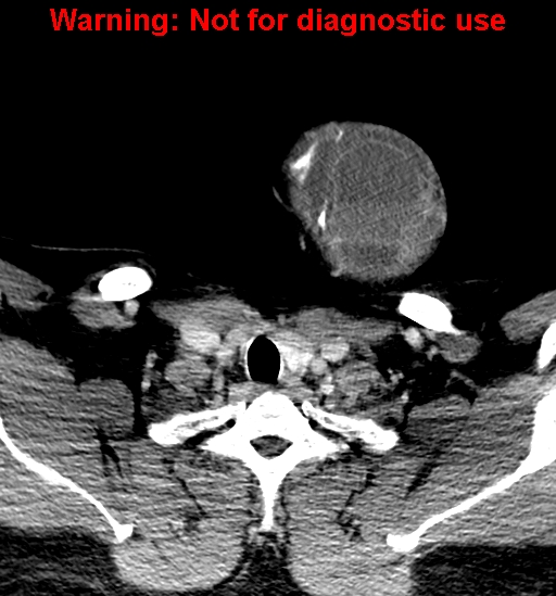 File:Ameloblastoma (Radiopaedia 33126-34164 B 39).jpg