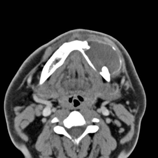 File:Ameloblastoma (Radiopaedia 33677-34806 Axial non-contrast 26).png