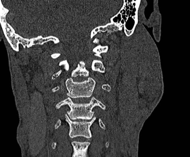Ameloblastoma (Radiopaedia 51921-57766 Coronal bone window 244).jpg