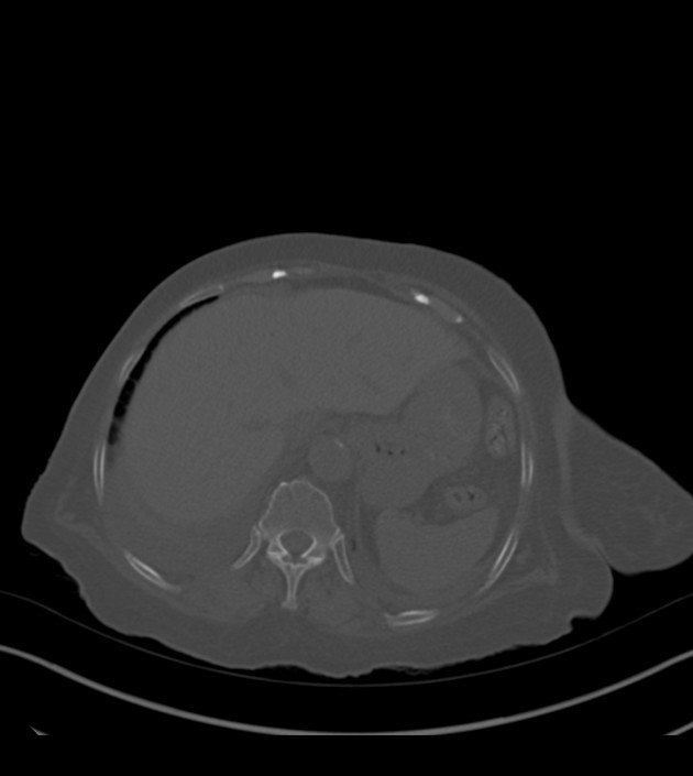Amiodarone deposition in the liver (Radiopaedia 77587-89780 Axial bone window 73).jpg