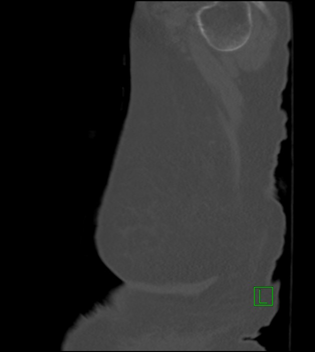 Amiodarone deposition in the liver (Radiopaedia 77587-89780 Sagittal bone window 6).jpg