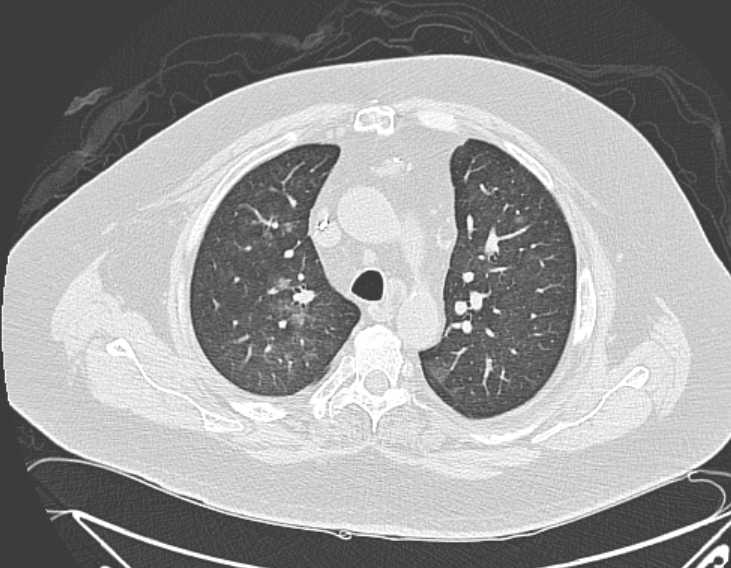 File:Amiodarone lung (Radiopaedia 62514-70769 Axial lung window 29).jpg