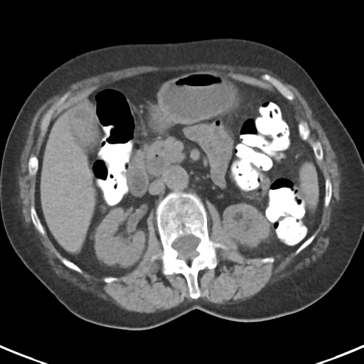 File:Ampullary adenocarcinoma (Radiopaedia 34013-35237 Axial non-contrast 22).png