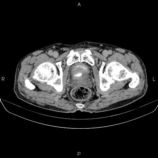 Ampullary adenocarcinoma (Radiopaedia 86093-102032 Axial C+ delayed 103).jpg