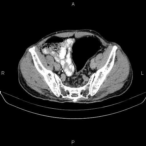 Ampullary adenocarcinoma (Radiopaedia 86093-102032 Axial C+ delayed 86).jpg