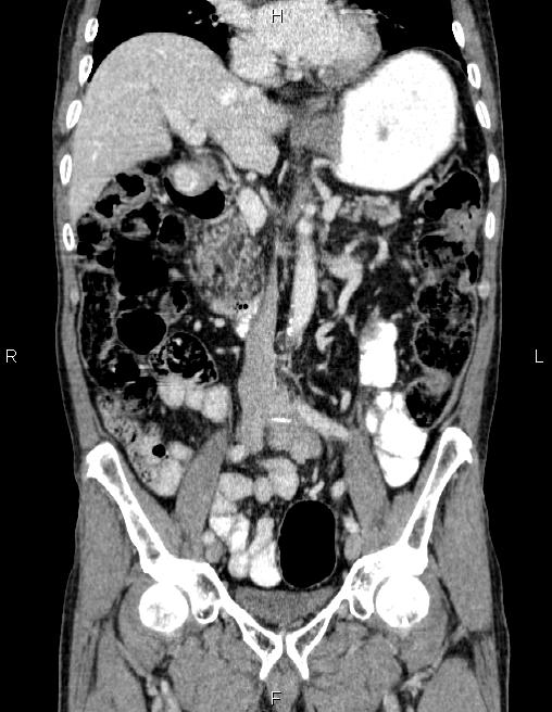 Ampullary adenocarcinoma (Radiopaedia 86093-102032 C 32).jpg
