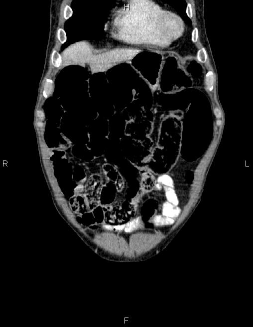 Ampullary adenocarcinoma (Radiopaedia 86093-102032 C 9).jpg