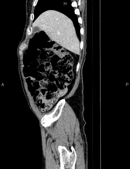 Ampullary adenocarcinoma (Radiopaedia 86093-102032 D 12).jpg