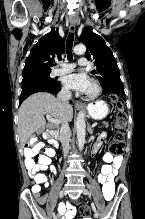 Ampullary adenocarcinoma (Radiopaedia 86093-102033 D 30).jpg