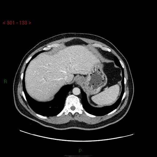 File:Ampullary carcinoma (Radiopaedia 56396-63056 C 16).jpg