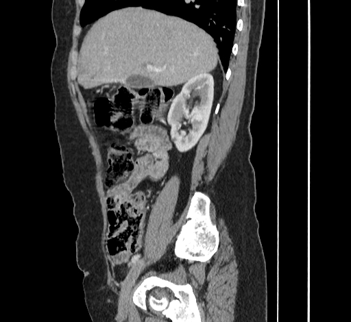 File:Ampullary tumor (Radiopaedia 60333-67998 C 16).jpg