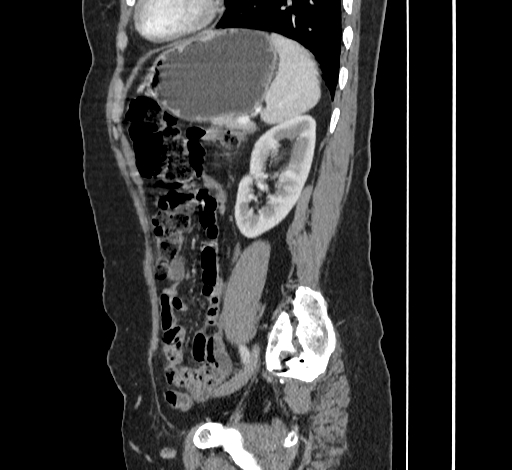 File:Ampullary tumor (Radiopaedia 60333-67998 C 44).jpg