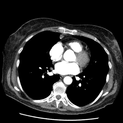 File:Amyloidosis - bronchial and diffuse nodular pulmonary involvement (Radiopaedia 60156-67745 A 32).jpg