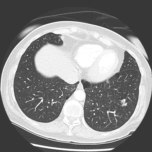 Amyloidosis - bronchial and diffuse nodular pulmonary involvement (Radiopaedia 60156-67745 Axial lung window 65).jpg