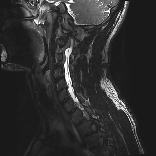 Amyotrophic lateral sclerosis (Radiopaedia 87352-103658 I 45).jpg