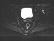File:Anal adenocarcinoma - tumor regression grade 1 (Radiopaedia 31358-32100 Axial DWI 19).jpg