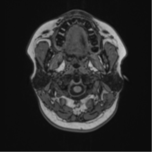 Anaplastic astroblastoma (Radiopaedia 55666-62194 Axial T1 1).png