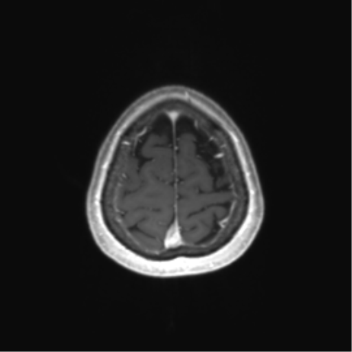 File:Anaplastic astrocytoma (Radiopaedia 86943-103160 Axial T1 C+ 81).png
