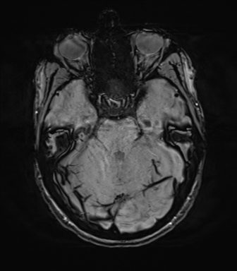 File:Anaplastic astrocytoma IDH mutant (Radiopaedia 50046-55341 Axial SWI 29).png