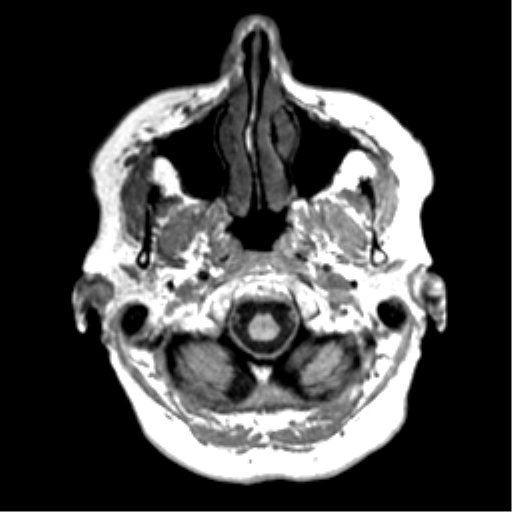 Anaplastic astrocytoma IDH wild-type (pseudoprogression) (Radiopaedia 42209-45277 Axial T1 8).png