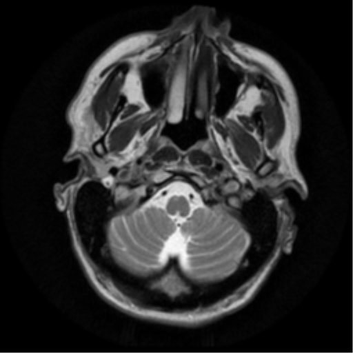 File:Anaplastic meningioma with recurrence (Radiopaedia 34452-35790 Axial T2 3).png