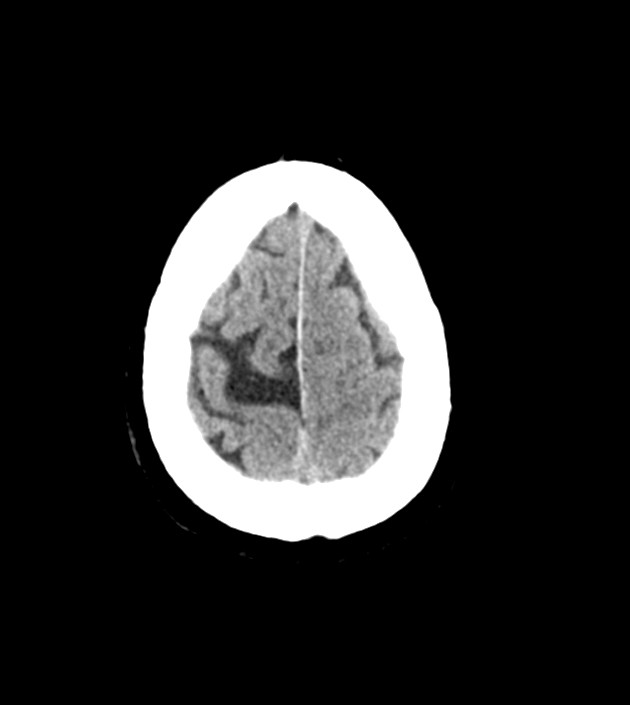 Anaplastic oligodendroglioma (Radiopaedia 79571-92758 Axial non-contrast 44).jpg