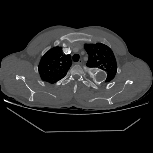 File:Aneurysmal bone cyst - rib (Radiopaedia 82167-96220 Axial bone window 80).jpg