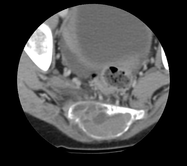 File:Aneurysmal bone cyst - sacrum (Radiopaedia 65190-74195 Axial non-contrast 34).jpg