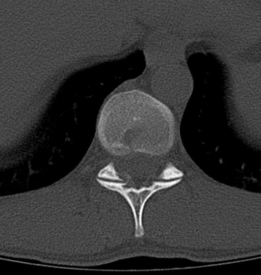 Aneurysmal bone cyst T11 (Radiopaedia 29294-29721 Axial bone window 37).jpg