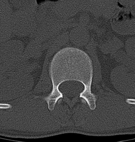 Aneurysmal bone cyst T11 (Radiopaedia 29294-29721 Axial bone window 62).jpg