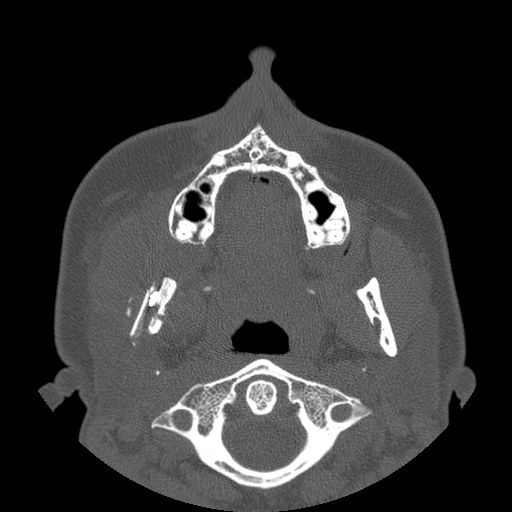 Aneurysmal bone cyst of the mandible (Radiopaedia 43280-46823 Axial bone window 93).jpg
