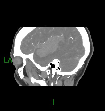 Aneurysmal subarachnoid hemorrhage with intra-axial extension (Radiopaedia 84371-99732 B 55).jpg
