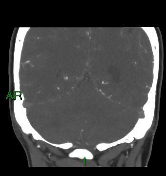 Aneurysmal subarachnoid hemorrhage with intra-axial extension (Radiopaedia 84371-99732 C 31).jpg