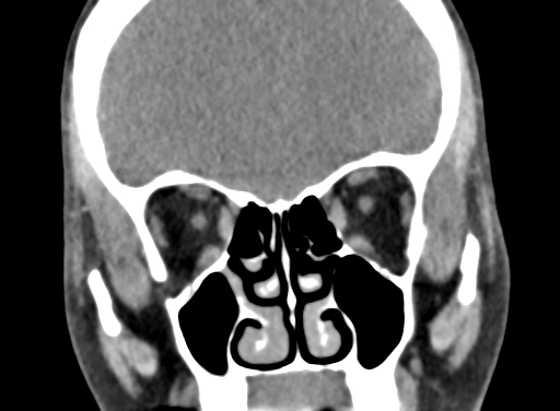 Angular dermoid cyst (Radiopaedia 88967-105790 Coronal non-contrast 32).jpg