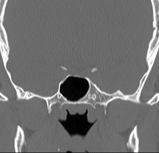 Angular epidermoid cyst (Radiopaedia 46908-51439 Coronal bone window 48).png