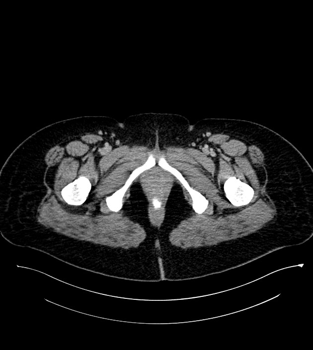 Anterior abdominal wall CSF pseudocyst (CSFoma) (Radiopaedia 79453-92571 A 96).jpg