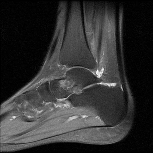 File:Anterior calcaneal process fracture (Radiopaedia 71377-81705 Sagittal PD fat sat 10).jpg