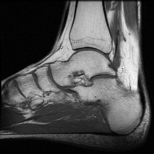 File:Anterior calcaneal process fracture (Radiopaedia 74654-85611 Sagittal T1 10).jpg