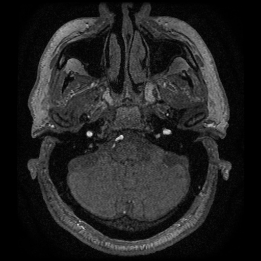 Anterior cerebral artery infarction (Radiopaedia 46794-51323 Axial MRA 11).jpg