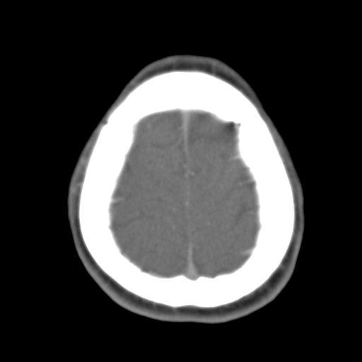 File:Anterior cerebral artery territory infarct (Radiopaedia 39327-41581 B 12).png